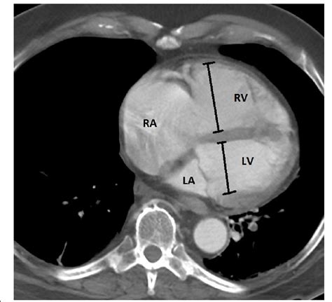 rv lv ratio on ct.